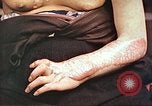 Image of medical care for atomic bomb victim Hiroshima Japan, 1946, second 26 stock footage video 65675060690