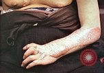 Image of medical care for atomic bomb victim Hiroshima Japan, 1946, second 27 stock footage video 65675060690