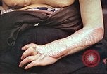 Image of medical care for atomic bomb victim Hiroshima Japan, 1946, second 28 stock footage video 65675060690