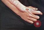 Image of medical care for atomic bomb victim Hiroshima Japan, 1946, second 29 stock footage video 65675060690