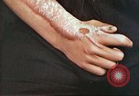 Image of medical care for atomic bomb victim Hiroshima Japan, 1946, second 30 stock footage video 65675060690
