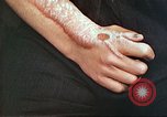 Image of medical care for atomic bomb victim Hiroshima Japan, 1946, second 34 stock footage video 65675060690