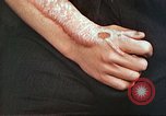 Image of medical care for atomic bomb victim Hiroshima Japan, 1946, second 35 stock footage video 65675060690