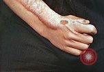 Image of medical care for atomic bomb victim Hiroshima Japan, 1946, second 36 stock footage video 65675060690