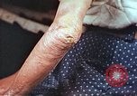Image coude et part ses blessures de bombe atomique Hiroshima au Japon, 1946, de la seconde 3 séquences d'archives historiques vidéo 65675060691