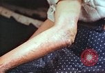Image coude et part ses blessures de bombe atomique Hiroshima au Japon, 1946, de la seconde 4 séquences d'archives historiques vidéo 65675060691