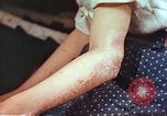 Image coude et part ses blessures de bombe atomique Hiroshima au Japon, 1946, de la seconde 5 séquences d'archives historiques vidéo 65675060691