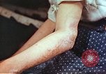 Image coude et part ses blessures de bombe atomique Hiroshima au Japon, 1946, de la seconde 6 séquences d'archives historiques vidéo 65675060691
