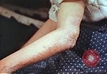 Image coude et part ses blessures de bombe atomique Hiroshima au Japon, 1946, de la seconde 7 séquences d'archives historiques vidéo 65675060691
