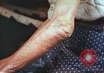 Image coude et part ses blessures de bombe atomique Hiroshima au Japon, 1946, de la seconde 8 séquences d'archives historiques vidéo 65675060691