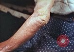 Image coude et part ses blessures de bombe atomique Hiroshima au Japon, 1946, de la seconde 9 séquences d'archives historiques vidéo 65675060691