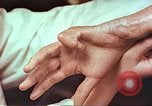 Image coude et part ses blessures de bombe atomique Hiroshima au Japon, 1946, de la seconde 10 séquences d'archives historiques vidéo 65675060691