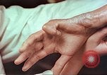 Image coude et part ses blessures de bombe atomique Hiroshima au Japon, 1946, de la seconde 11 séquences d'archives historiques vidéo 65675060691
