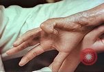 Image coude et part ses blessures de bombe atomique Hiroshima au Japon, 1946, de la seconde 12 séquences d'archives historiques vidéo 65675060691