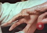 Image coude et part ses blessures de bombe atomique Hiroshima au Japon, 1946, de la seconde 13 séquences d'archives historiques vidéo 65675060691