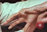 Image coude et part ses blessures de bombe atomique Hiroshima au Japon, 1946, de la seconde 14 séquences d'archives historiques vidéo 65675060691