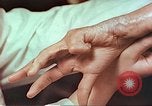 Image coude et part ses blessures de bombe atomique Hiroshima au Japon, 1946, de la seconde 15 séquences d'archives historiques vidéo 65675060691