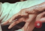 Image coude et part ses blessures de bombe atomique Hiroshima au Japon, 1946, de la seconde 16 séquences d'archives historiques vidéo 65675060691