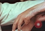 Image coude et part ses blessures de bombe atomique Hiroshima au Japon, 1946, de la seconde 17 séquences d'archives historiques vidéo 65675060691