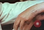 Image coude et part ses blessures de bombe atomique Hiroshima au Japon, 1946, de la seconde 18 séquences d'archives historiques vidéo 65675060691