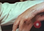 Image coude et part ses blessures de bombe atomique Hiroshima au Japon, 1946, de la seconde 19 séquences d'archives historiques vidéo 65675060691