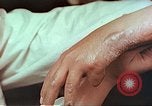 Image coude et part ses blessures de bombe atomique Hiroshima au Japon, 1946, de la seconde 20 séquences d'archives historiques vidéo 65675060691