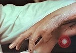 Image coude et part ses blessures de bombe atomique Hiroshima au Japon, 1946, de la seconde 21 séquences d'archives historiques vidéo 65675060691