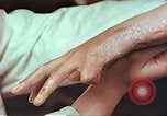 Image coude et part ses blessures de bombe atomique Hiroshima au Japon, 1946, de la seconde 24 séquences d'archives historiques vidéo 65675060691