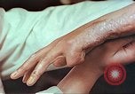 Image coude et part ses blessures de bombe atomique Hiroshima au Japon, 1946, de la seconde 25 séquences d'archives historiques vidéo 65675060691