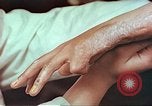 Image coude et part ses blessures de bombe atomique Hiroshima au Japon, 1946, de la seconde 26 séquences d'archives historiques vidéo 65675060691