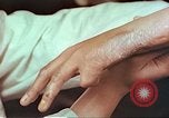 Image coude et part ses blessures de bombe atomique Hiroshima au Japon, 1946, de la seconde 28 séquences d'archives historiques vidéo 65675060691