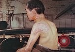 Image of neck and head wounds from atomic bomb Hiroshima Japan, 1946, second 3 stock footage video 65675060692