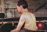 Image of neck and head wounds from atomic bomb Hiroshima Japan, 1946, second 4 stock footage video 65675060692