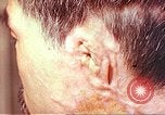 Image of neck and head wounds from atomic bomb Hiroshima Japan, 1946, second 9 stock footage video 65675060692