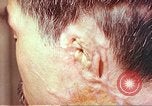 Image of neck and head wounds from atomic bomb Hiroshima Japan, 1946, second 13 stock footage video 65675060692