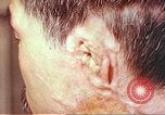 Image of neck and head wounds from atomic bomb Hiroshima Japan, 1946, second 14 stock footage video 65675060692