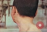 Image of skin wounds from atomic bomb burn Hiroshima Japan, 1946, second 3 stock footage video 65675060693