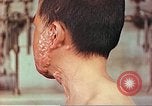 Image of skin wounds from atomic bomb burn Hiroshima Japan, 1946, second 4 stock footage video 65675060693