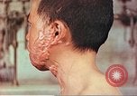 Image of skin wounds from atomic bomb burn Hiroshima Japan, 1946, second 5 stock footage video 65675060693
