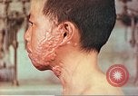 Image of skin wounds from atomic bomb burn Hiroshima Japan, 1946, second 6 stock footage video 65675060693