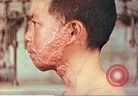 Image of skin wounds from atomic bomb burn Hiroshima Japan, 1946, second 7 stock footage video 65675060693