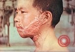 Image of skin wounds from atomic bomb burn Hiroshima Japan, 1946, second 8 stock footage video 65675060693