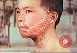 Image of skin wounds from atomic bomb burn Hiroshima Japan, 1946, second 9 stock footage video 65675060693