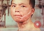 Image of skin wounds from atomic bomb burn Hiroshima Japan, 1946, second 10 stock footage video 65675060693