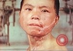 Image of skin wounds from atomic bomb burn Hiroshima Japan, 1946, second 11 stock footage video 65675060693