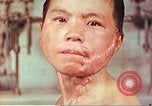 Image of skin wounds from atomic bomb burn Hiroshima Japan, 1946, second 12 stock footage video 65675060693