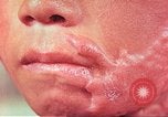 Image of skin wounds from atomic bomb burn Hiroshima Japan, 1946, second 15 stock footage video 65675060693