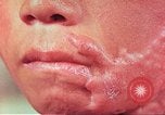 Image of skin wounds from atomic bomb burn Hiroshima Japan, 1946, second 16 stock footage video 65675060693