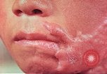 Image of skin wounds from atomic bomb burn Hiroshima Japan, 1946, second 17 stock footage video 65675060693