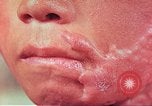 Image of skin wounds from atomic bomb burn Hiroshima Japan, 1946, second 18 stock footage video 65675060693
